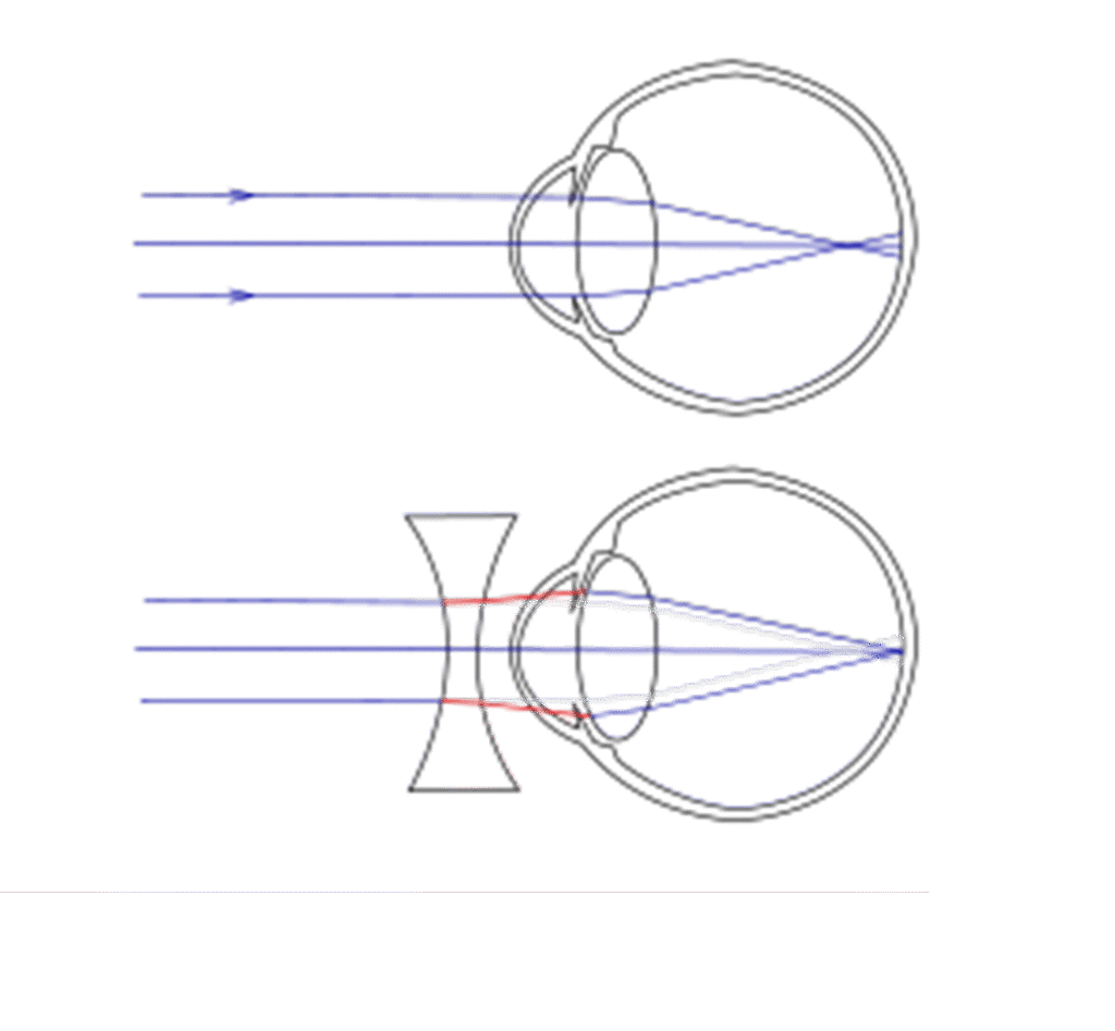 CLASS 10 Science | Chapter- HUMAN EYE and Colourful World | myopia