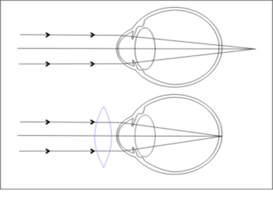 CLASS 10 Science | Chapter- HUMAN EYE and Colourful World | hypermetropia